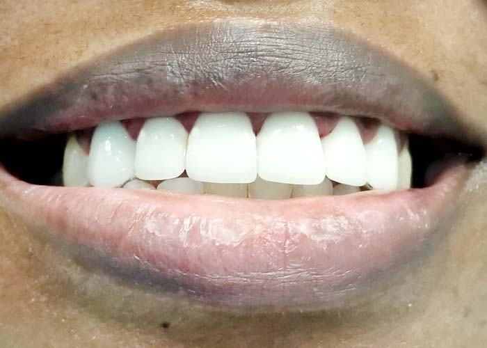 After cosmetic treatment: aligned, white smile