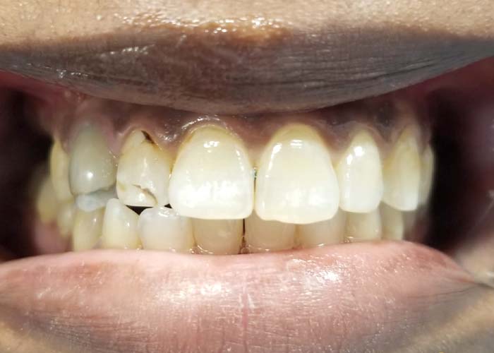 Before cosmetic treatment: chipped and uneven front teeth