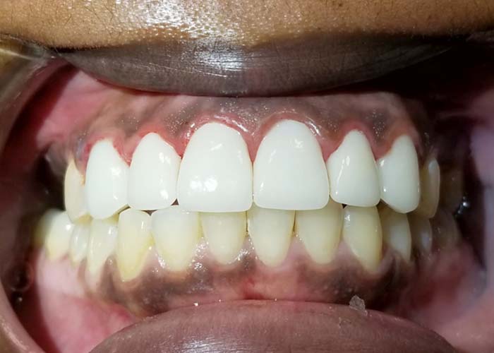After cosmetic treatment: even, bright front teeth