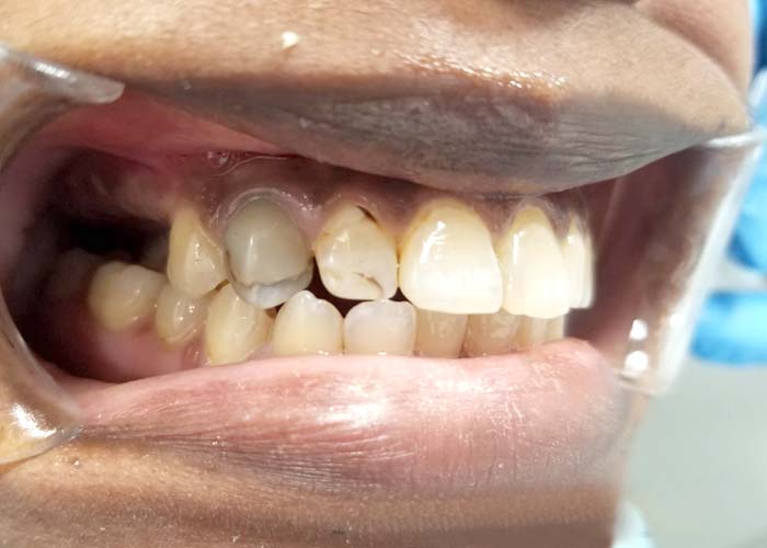 Before cosmetic treatment: stained and crowded teeth