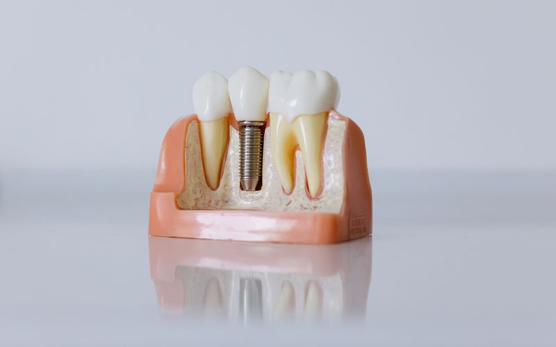 Dental Implants vs. Dentures: What's Right for You? 1 Dental implants vs dentures at Pines True Smile Pembroke Pines